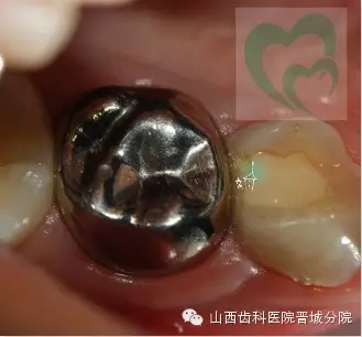 乳牙預(yù)成冠&mdash;&mdash;大面積乳牙齲壞的首選辦法