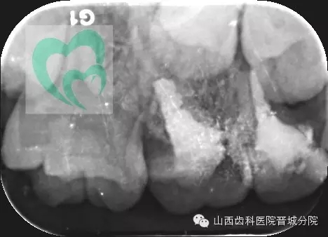 乳牙預(yù)成冠&mdash;&mdash;大面積乳牙齲壞的首選辦法