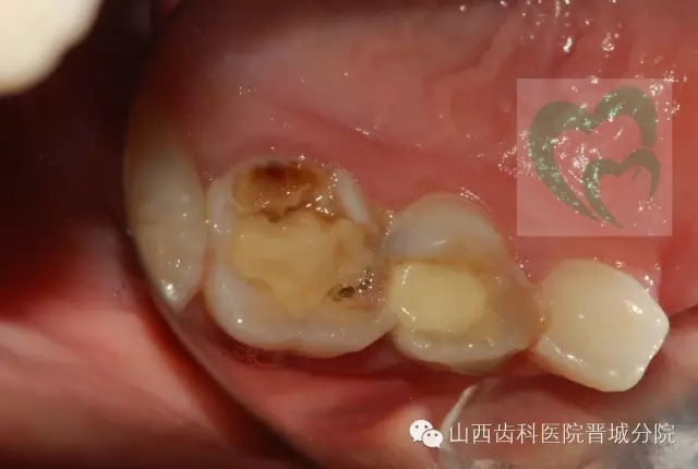 乳牙預(yù)成冠&mdash;&mdash;大面積乳牙齲壞的首選辦法