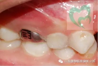 乳牙預(yù)成冠&mdash;&mdash;大面積乳牙齲壞的首選辦法