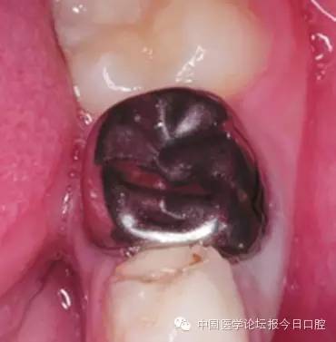 兒童乳牙金屬預(yù)成冠的臨床應(yīng)用 兒童乳牙金屬預(yù)成冠的臨床應(yīng)用