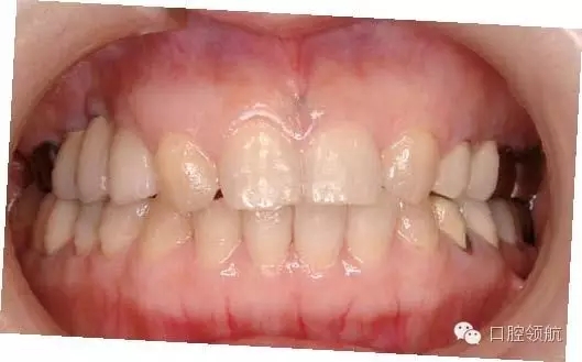 兩次手術(shù)法植入植體后數(shù)天，覆蓋螺絲暴露