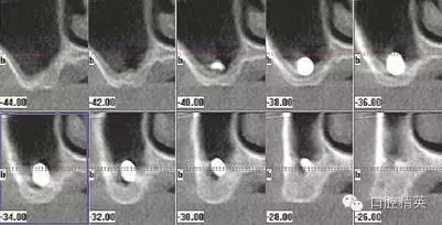 口腔種植各種失敗模式的病因探查 口腔種植各種失敗模式的病因探查