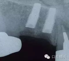 口腔種植各種失敗模式的病因探查 口腔種植各種失敗模式的病因探查