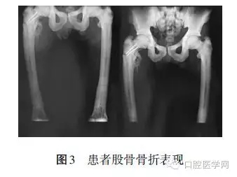 頜骨骨髓炎X線影像 頜骨骨髓炎X線影像