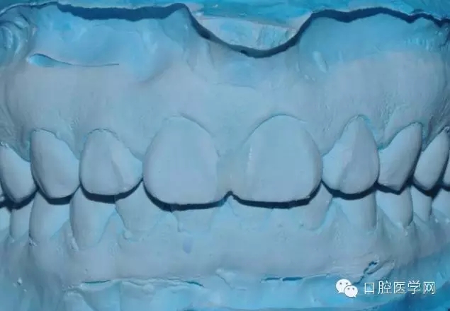 樹脂關(guān)閉前牙間隙 樹脂關(guān)閉前牙間隙