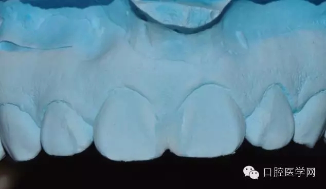 樹脂關(guān)閉前牙間隙 樹脂關(guān)閉前牙間隙