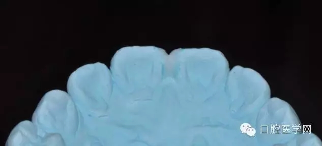 樹脂關(guān)閉前牙間隙 樹脂關(guān)閉前牙間隙