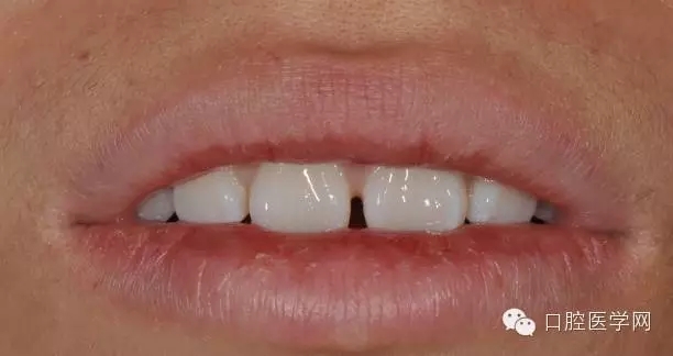 樹脂關(guān)閉前牙間隙 樹脂關(guān)閉前牙間隙