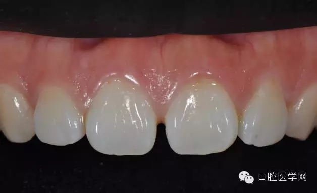 樹脂關(guān)閉前牙間隙 樹脂關(guān)閉前牙間隙