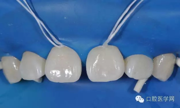 樹脂關(guān)閉前牙間隙 樹脂關(guān)閉前牙間隙