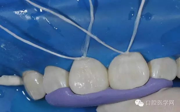 樹脂關(guān)閉前牙間隙 樹脂關(guān)閉前牙間隙