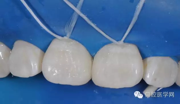 樹脂關(guān)閉前牙間隙 樹脂關(guān)閉前牙間隙