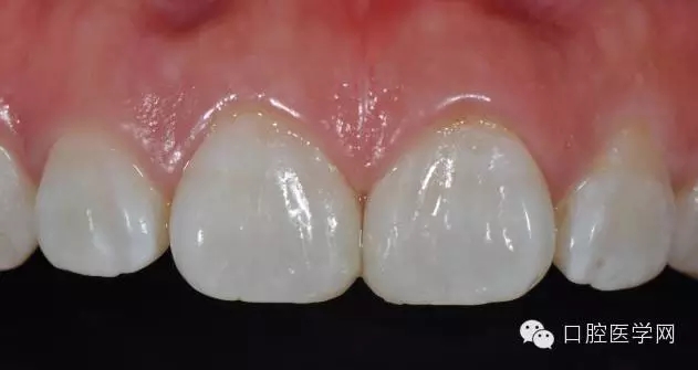 6樹脂關(guān)閉前牙間隙 6樹脂關(guān)閉前牙間隙