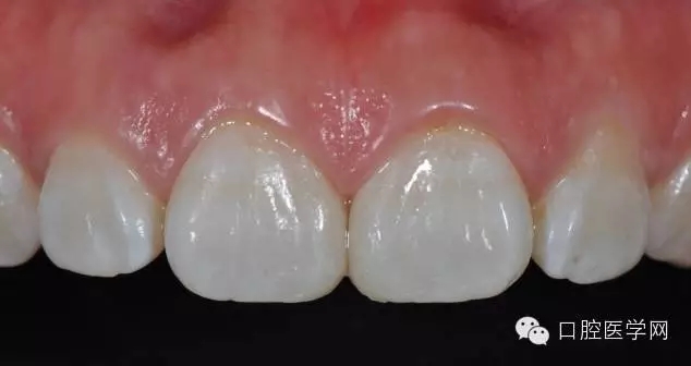 樹脂關(guān)閉前牙間隙 樹脂關(guān)閉前牙間隙