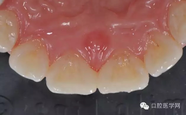 樹脂關(guān)閉前牙間隙 樹脂關(guān)閉前牙間隙