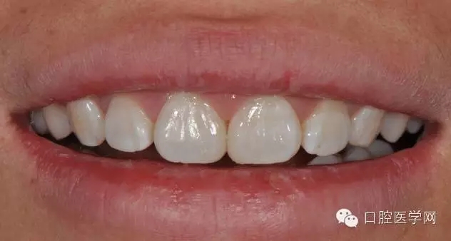 樹脂關(guān)閉前牙間隙 樹脂關(guān)閉前牙間隙
