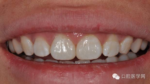 樹脂關(guān)閉前牙間隙 樹脂關(guān)閉前牙間隙