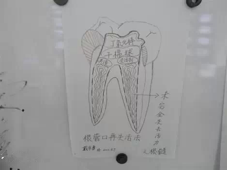 牙科醫(yī)生必收藏:實(shí)用簡單清理殘髓(干貨分享) 牙科醫(yī)生必收藏:實(shí)用簡單清理殘髓(干貨分享)