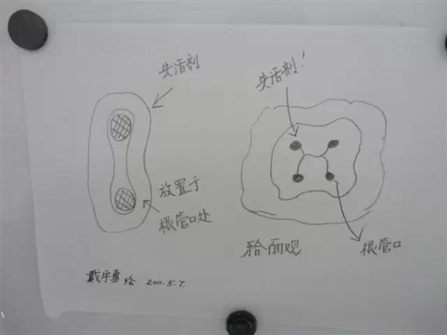 牙科醫(yī)生必收藏:實(shí)用簡單清理殘髓(干貨分享) 牙科醫(yī)生必收藏:實(shí)用簡單清理殘髓(干貨分享)