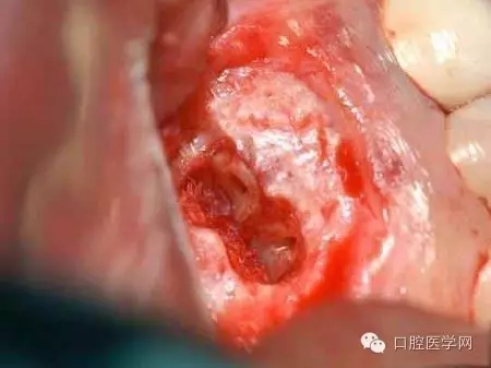 根尖切除術(shù)操作全過程