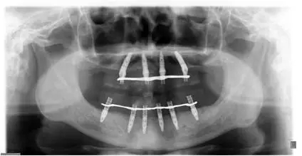 All-on-4上頜種植失敗一例及處理方法解析 All-on-4上頜種植失敗一例及處理方法解析