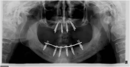 All-on-4上頜種植失敗一例及處理方法解析 All-on-4上頜種植失敗一例及處理方法解析
