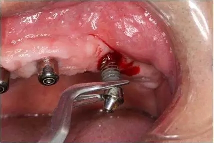 All-on-4上頜種植失敗一例及處理方法解析 All-on-4上頜種植失敗一例及處理方法解析