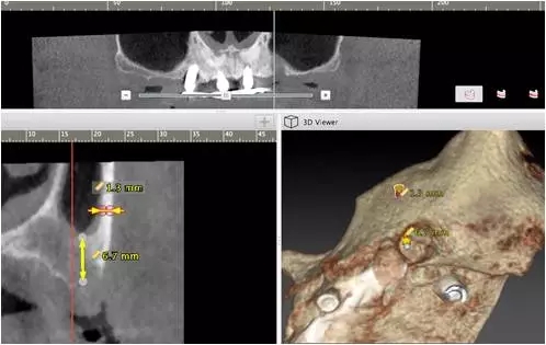 All-on-4上頜種植失敗一例及處理方法解析 All-on-4上頜種植失敗一例及處理方法解析