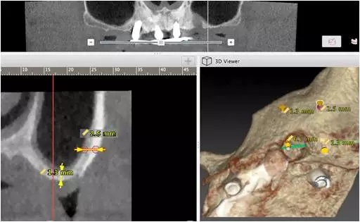 All-on-4上頜種植失敗一例及處理方法解析 All-on-4上頜種植失敗一例及處理方法解析