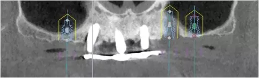All-on-4上頜種植失敗一例及處理方法解析 All-on-4上頜種植失敗一例及處理方法解析