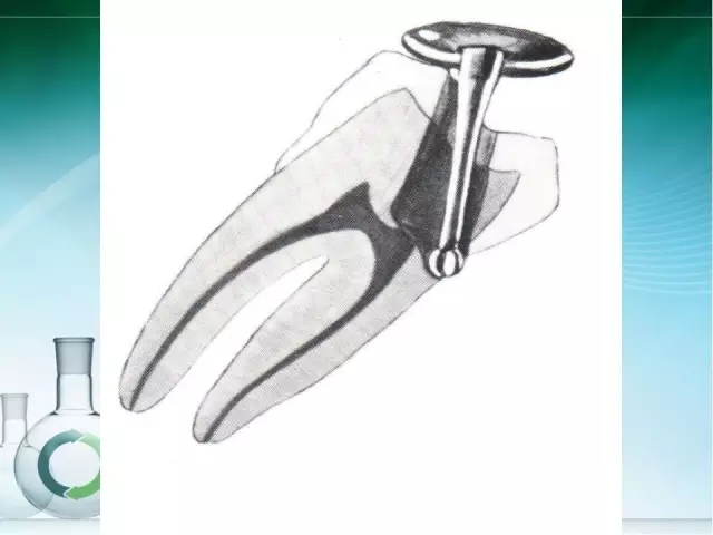 根管治療并發(fā)癥及處理 根管治療并發(fā)癥及處理