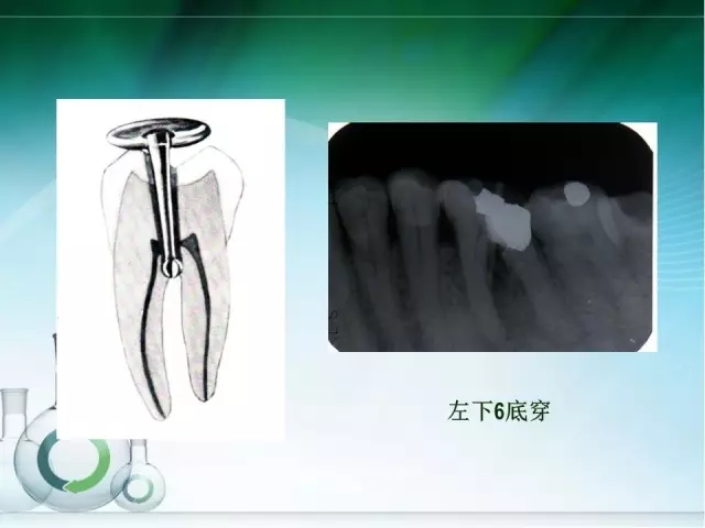 根管治療并發(fā)癥及處理 根管治療并發(fā)癥及處理