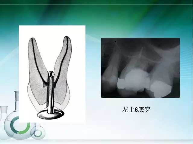 根管治療并發(fā)癥及處理 根管治療并發(fā)癥及處理