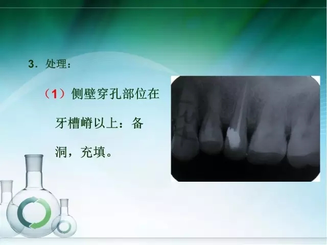 根管治療并發(fā)癥及處理 根管治療并發(fā)癥及處理