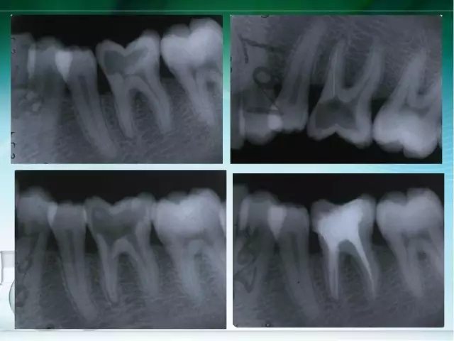 根管治療并發(fā)癥及處理 根管治療并發(fā)癥及處理
