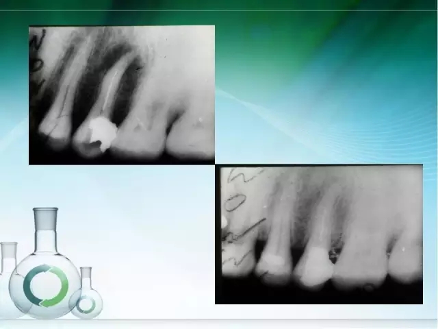 根管治療并發(fā)癥及處理 根管治療并發(fā)癥及處理