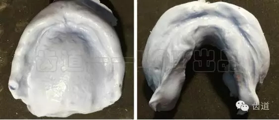 胡常紅:疑難全口義齒閉口式印模病例解說 胡常紅:疑難全口義齒閉口式印模病例解說