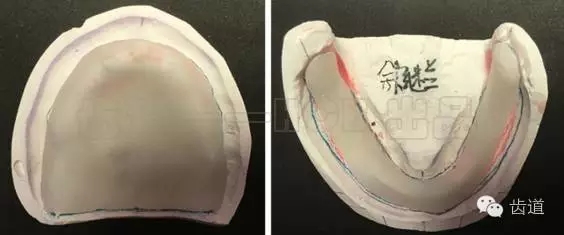 胡常紅:疑難全口義齒閉口式印模病例解說 胡常紅:疑難全口義齒閉口式印模病例解說