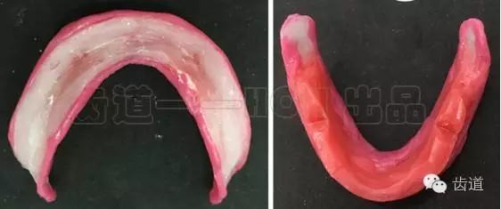 胡常紅:疑難全口義齒閉口式印模病例解說 胡常紅:疑難全口義齒閉口式印模病例解說