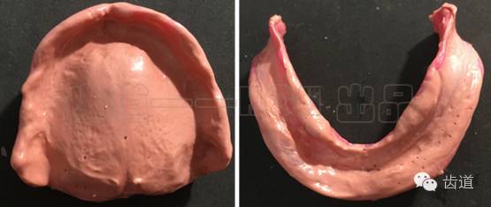 胡常紅:疑難全口義齒閉口式印模病例解說 胡常紅:疑難全口義齒閉口式印模病例解說