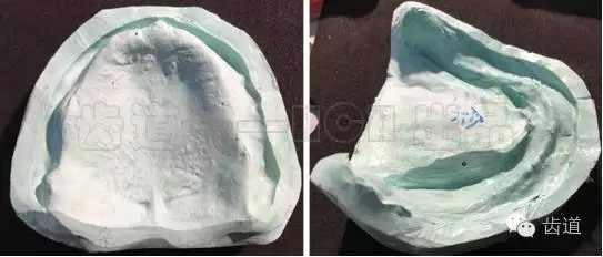 胡常紅:疑難全口義齒閉口式印模病例解說 胡常紅:疑難全口義齒閉口式印模病例解說