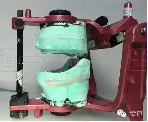 胡常紅:疑難全口義齒閉口式印模病例解說 胡常紅:疑難全口義齒閉口式印模病例解說