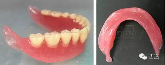 胡常紅:疑難全口義齒閉口式印模病例解說 胡常紅:疑難全口義齒閉口式印模病例解說