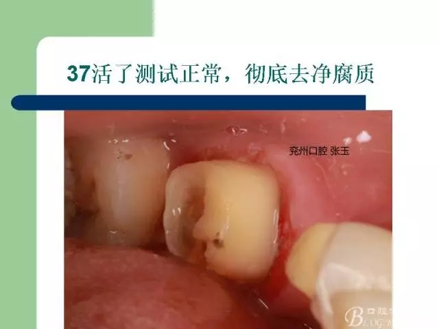 左下后牙不良修復(fù)體拆除后重新修復(fù)一例 左下后牙不良修復(fù)體拆除后重新修復(fù)一例