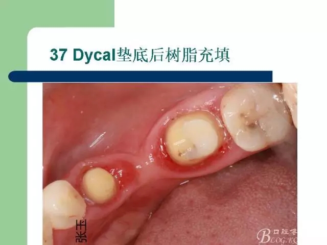左下后牙不良修復(fù)體拆除后重新修復(fù)一例 左下后牙不良修復(fù)體拆除后重新修復(fù)一例