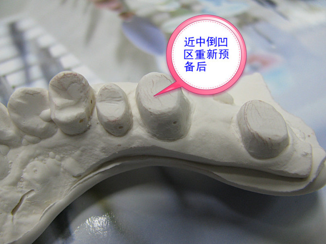 口腔修復(fù)醫(yī)生備牙取摸常見問題系列之——基牙倒凹 與 備牙時“就位道”的處理 口腔修復(fù)醫(yī)生備牙取摸常見問題系列之——基牙倒凹 與 備牙時“就位道”的處理