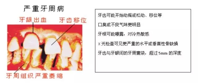 【科普】牙周病的預(yù)防和治療