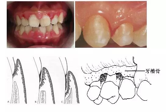 【科普】牙周病的預(yù)防和治療