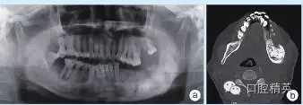 頜骨良性成牙骨質(zhì)細(xì)胞瘤 頜骨良性成牙骨質(zhì)細(xì)胞瘤